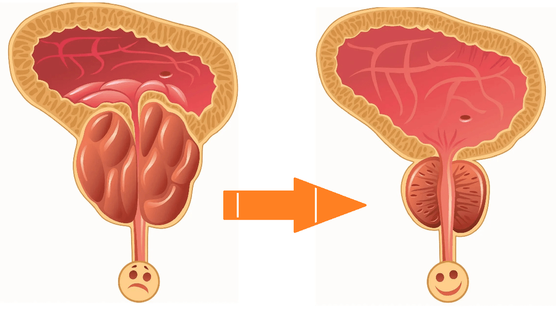 Uromexil Forte Prostatitis eta Adenomarekin prostatako ekintza