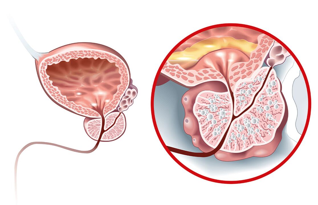 Zer gertatzen da prostatarekin adenoma eta prostatitisarekin