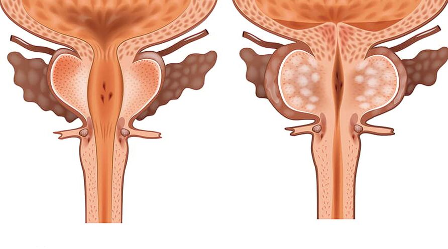 adenoma osasuntsu eta hanturazkoen alderaketa