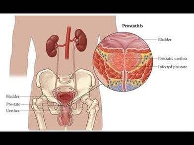 Prostatitis - prostatako guruinaren hantura