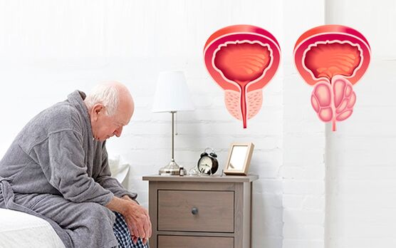 prostatitisa gizon batean
